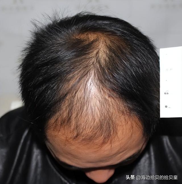 子最好？育发液什么牌子最有效果？pg模拟器试玩日本生发液哪个牌(图3)